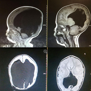 Estas tomografías muestran la evolución del cerebro del niño.